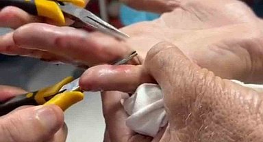 Batman yaşlı adamın parmağına sıkışan yüzük hastanede çıkarıldı