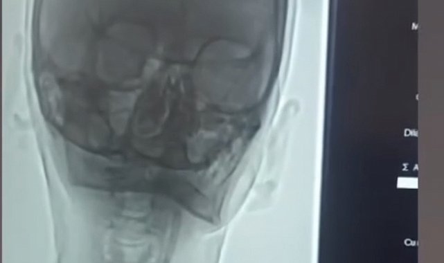 Iğdır'da şah damarı darlığına stentli müdahale