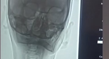 Iğdır'da şah damarı darlığına stentli müdahale