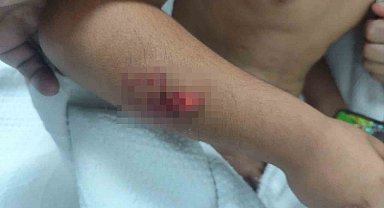 Köpek saldırısına uğrayan çocuğun başına 15 dikiş atıldı