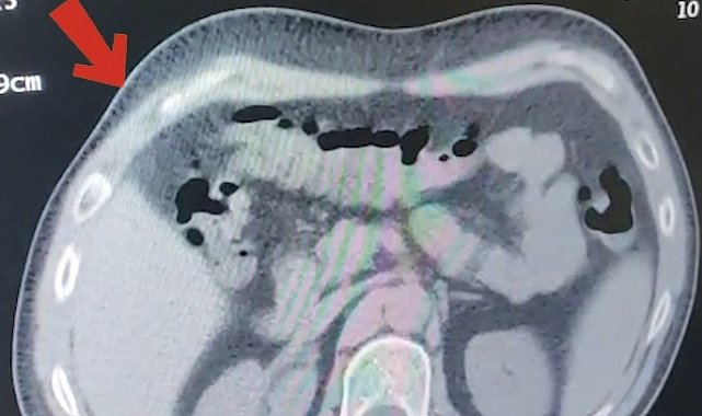 Mide ve bağırsaklarından 608 gram metamfetamin çıktı