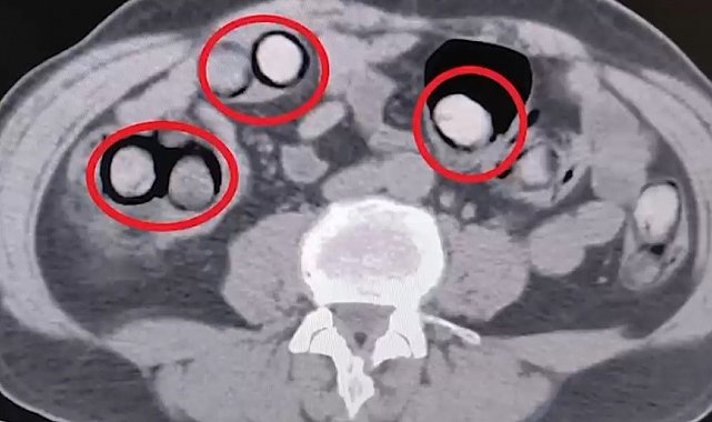 Mide ve bağırsaklarından 758 gram uyuşturucu çıktı