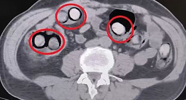 Mide ve bağırsaklarından 758 gram uyuşturucu çıktı