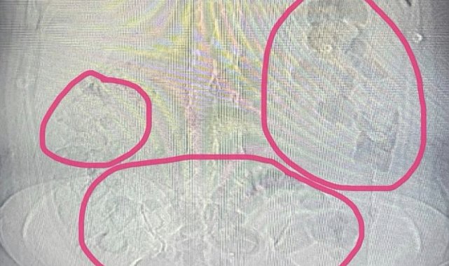 Midesinden uyuşturucu çıkan şahıs tutuklandı