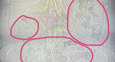Midesinden uyuşturucu çıkan şahıs tutuklandı