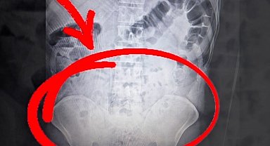 Uyuşturucuyu midelerinde taşıdılar: 4 tutuklama